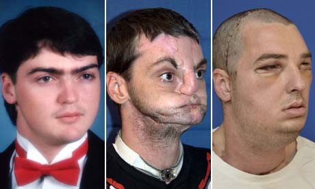 Richard Norris is seen before and after his face transplant operation. Norris of Hillsville, Virginia, was shot in the face in 1997. Photograph: Reuters