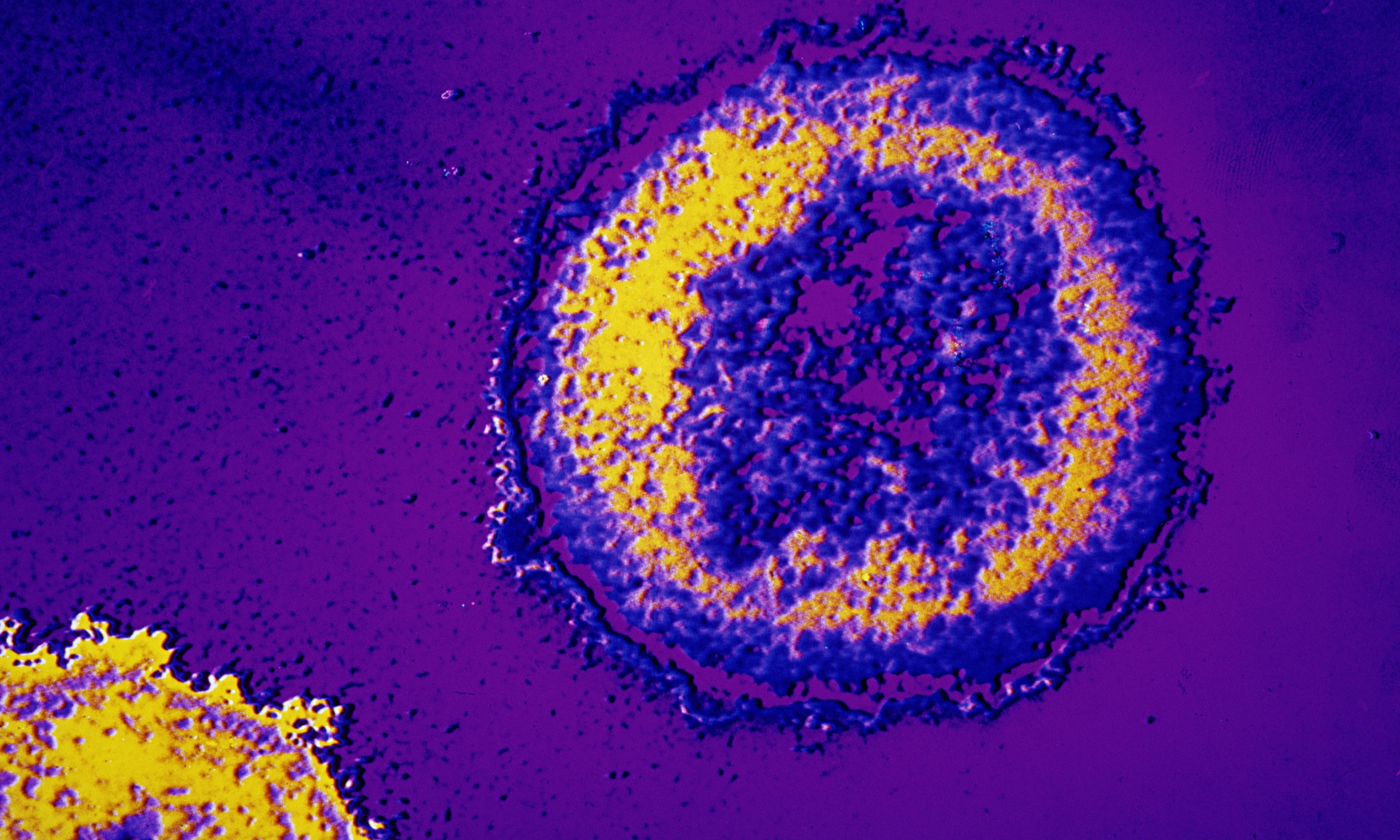Спид похожие. Вирус иммунодефицита под микроскопом. ВИЧ инфекция под микроскопом. Вирус СПИДА под микроскопом. Микрофотография вируса ВИЧ.