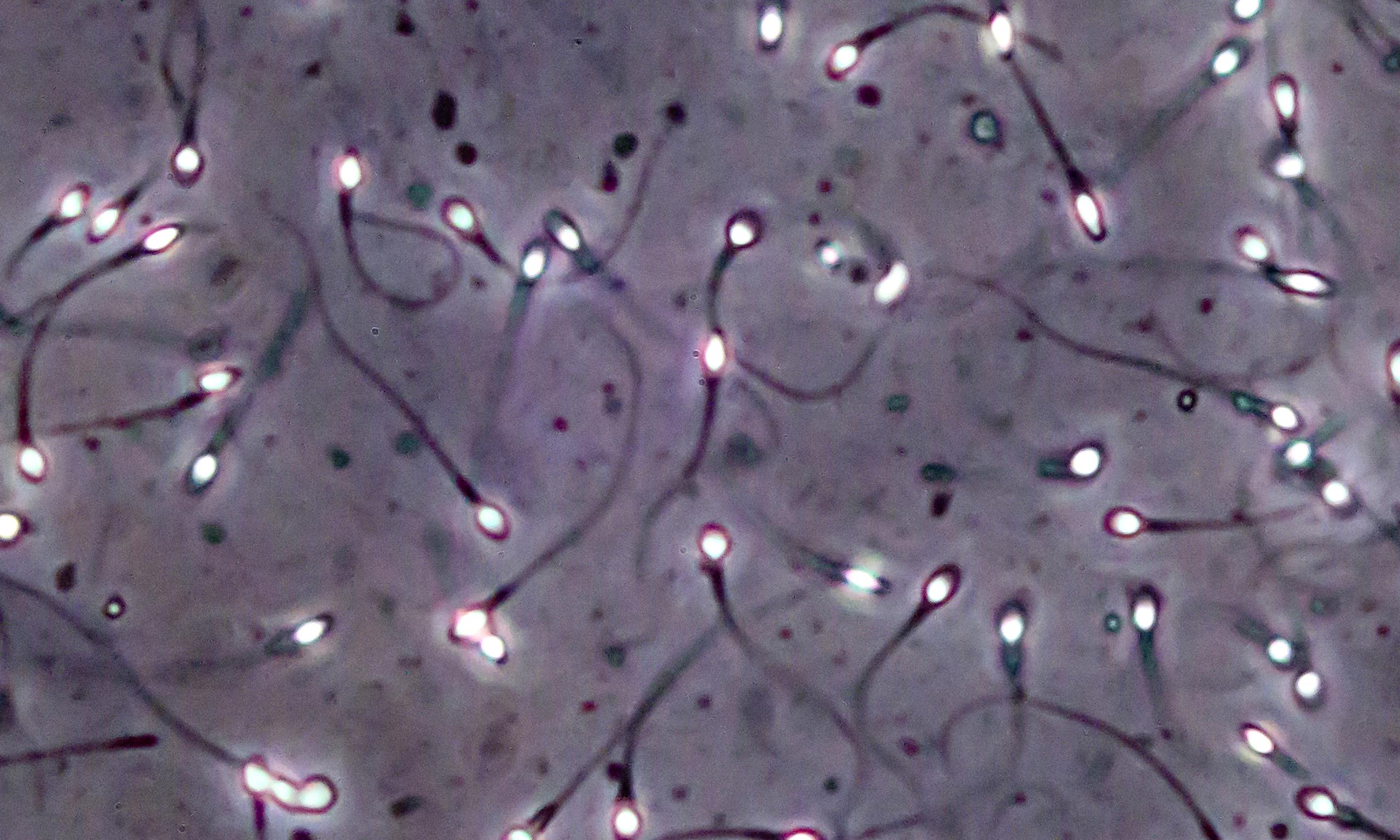 Study turns skin tissue from infertile men into early-stage sperm cells